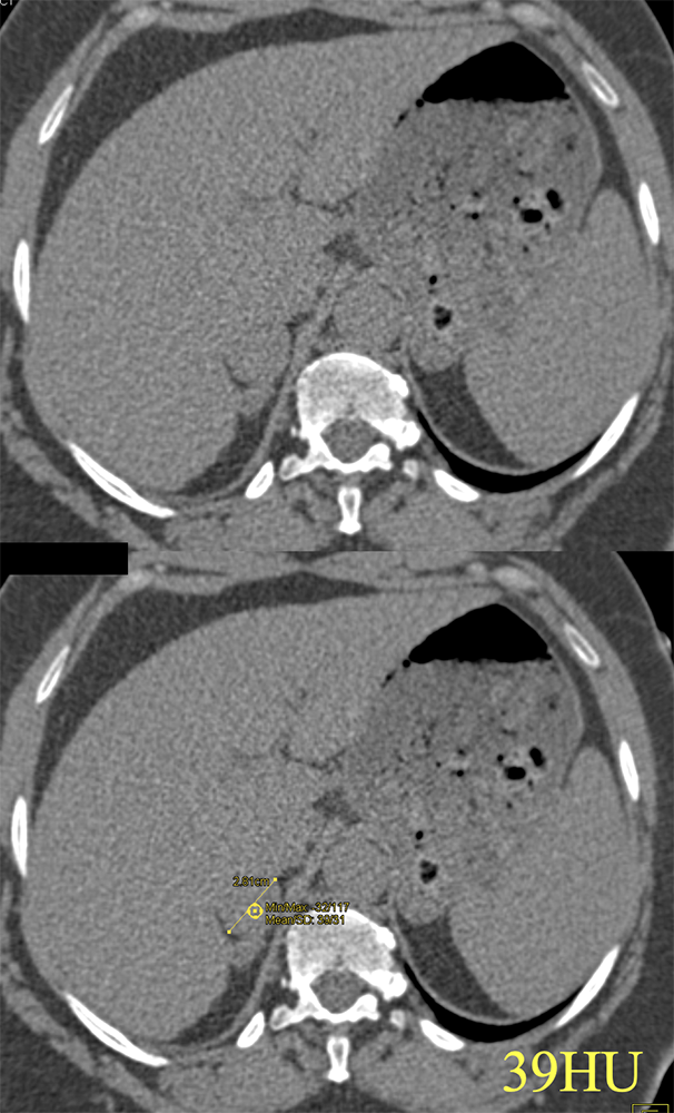 Adrenal Adenoma vs Pheo: Enhances >120HU