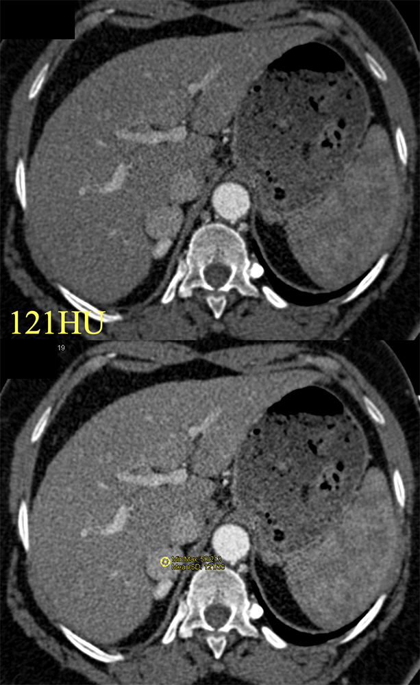 CT of the Adrenal Mass