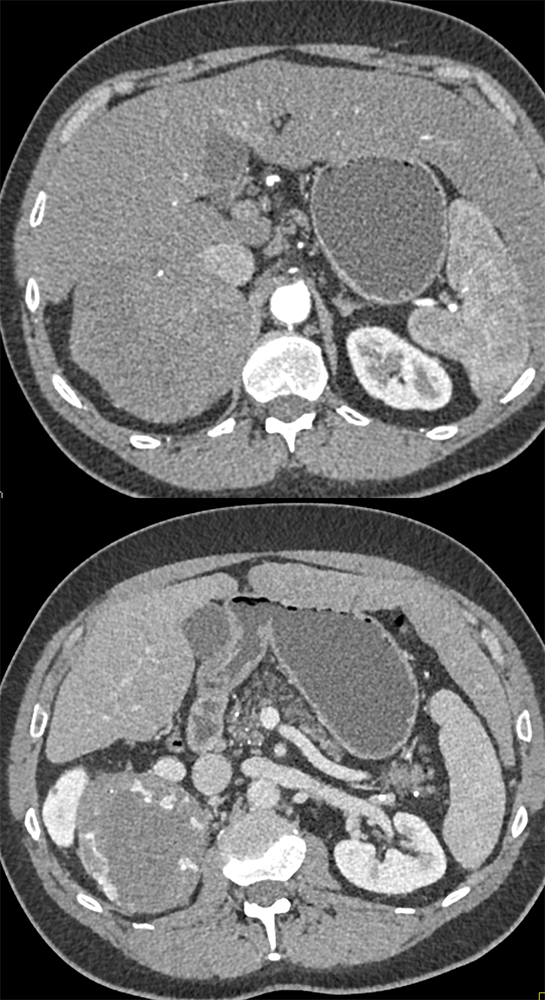 10.5 cm Adrenal Cortical Adenoma