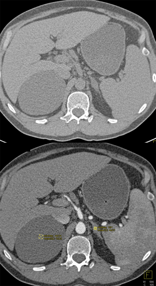 Adrenal Cyst