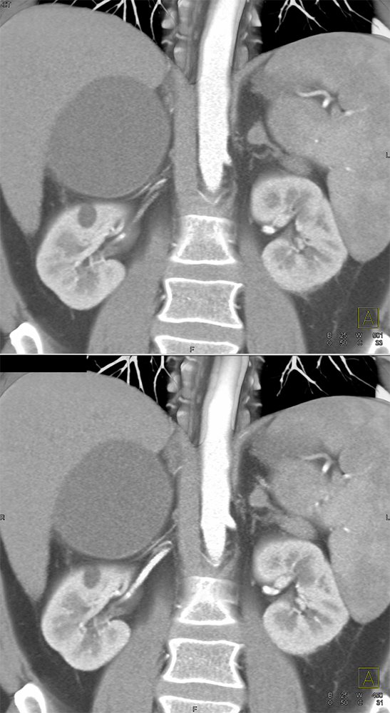 CT of the Adrenal Mass