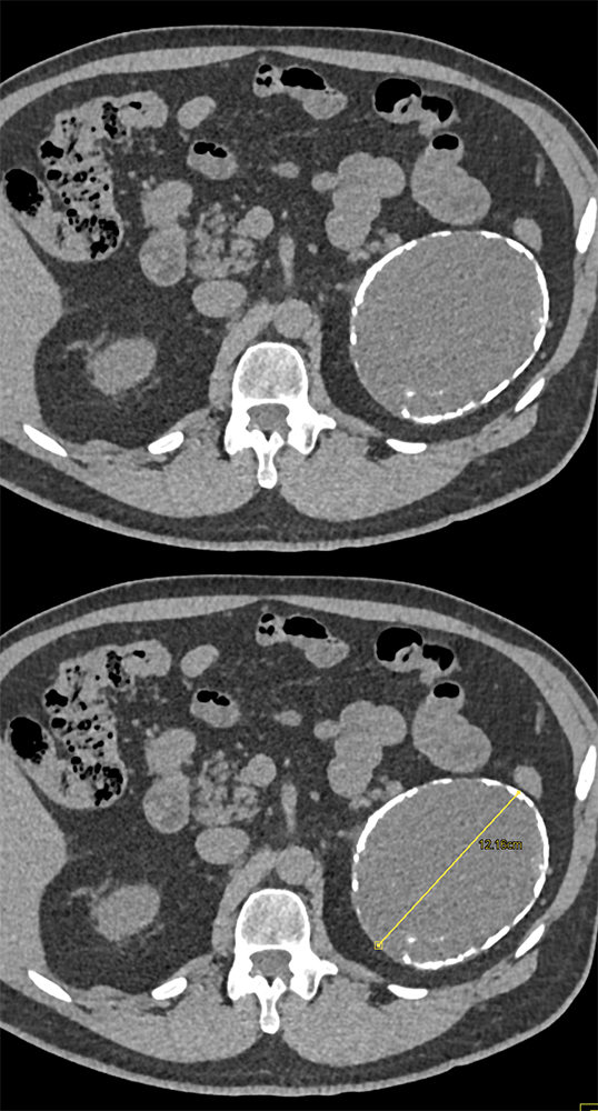 Calcified Adrenal Mass 12cm was Endothelial Cyst