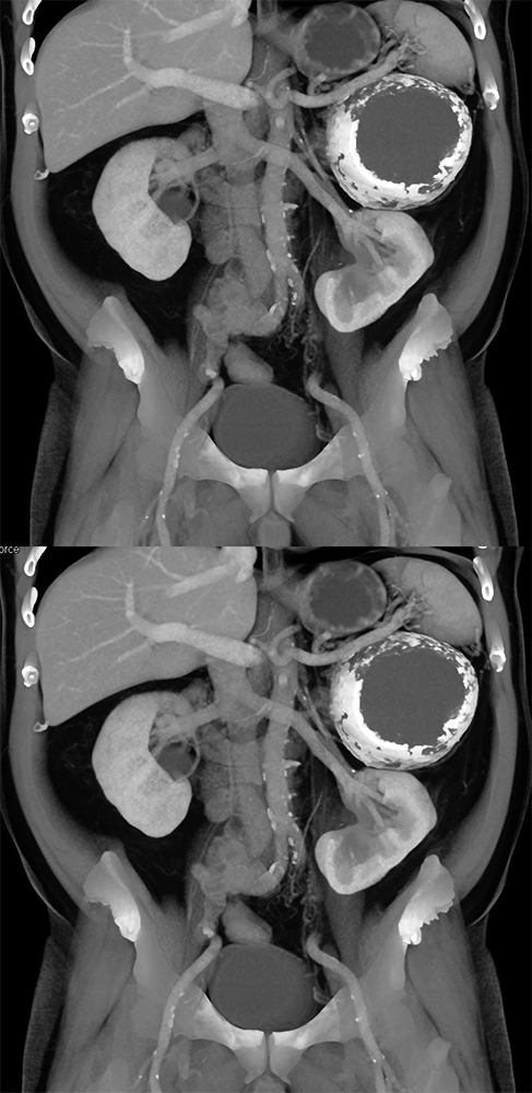 CT of the Adrenal Mass