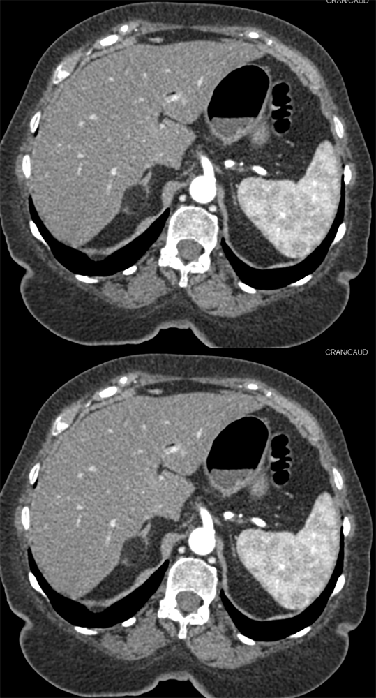 Adrenal AML