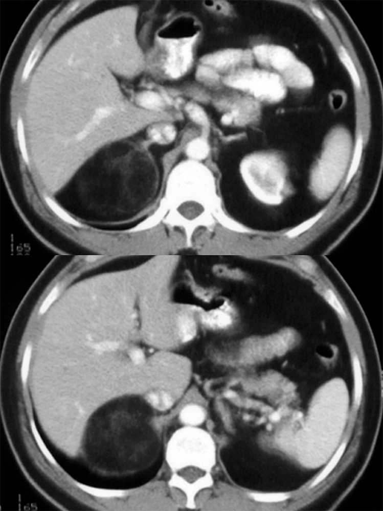 Adrenal Myelolipoma