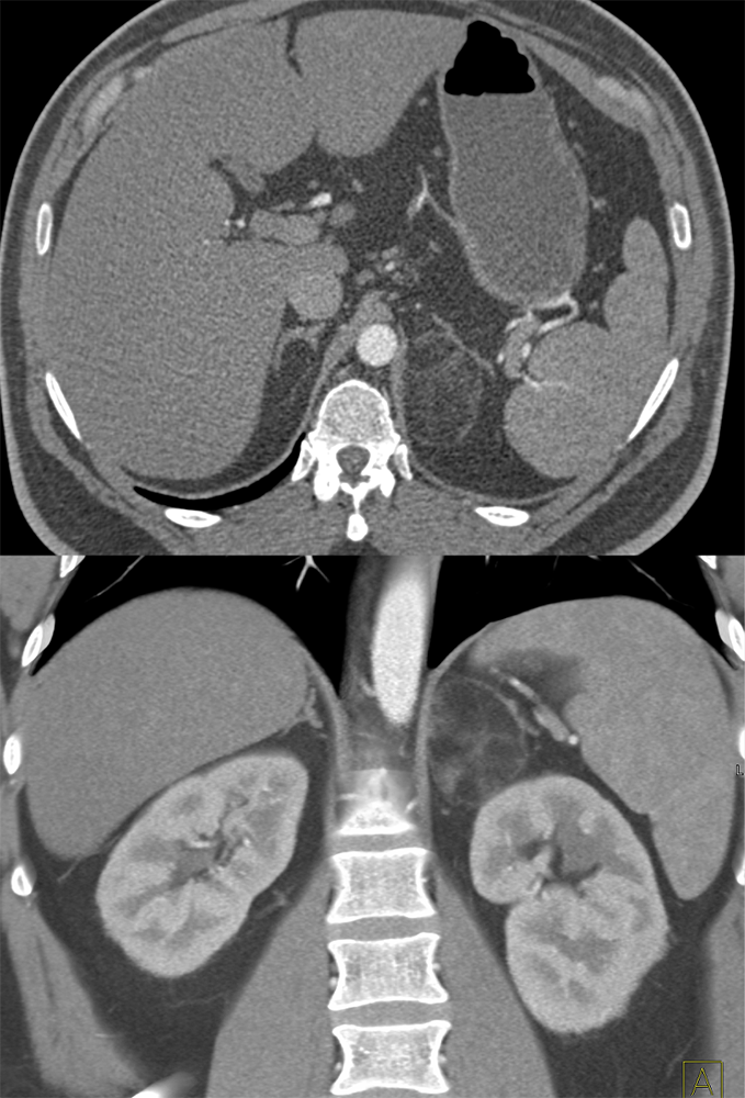 Adrenal Myelolipoma