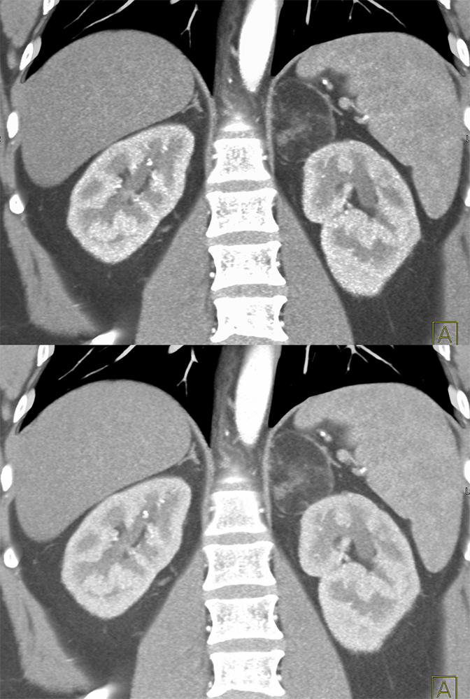 CT of the Adrenal Mass