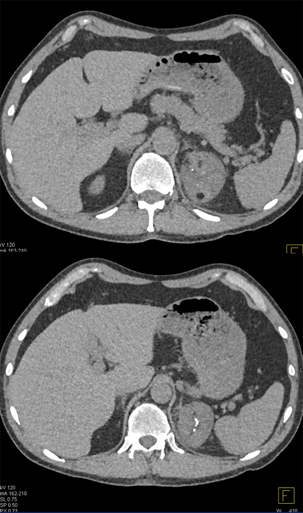 Adrenal Myelolipoma