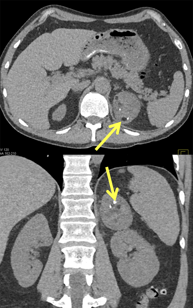 CT of the Adrenal Mass