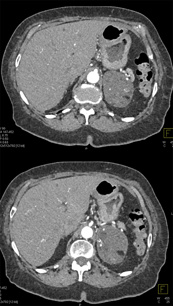 Incidental FindingLarge Adrenal Myelolipoma