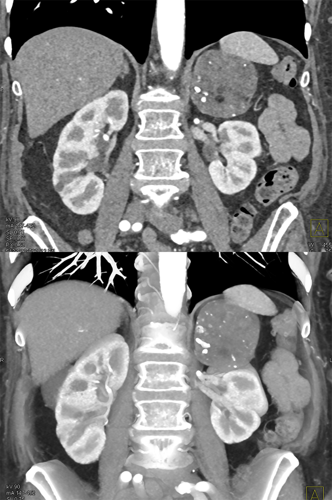 CT of the Adrenal Mass