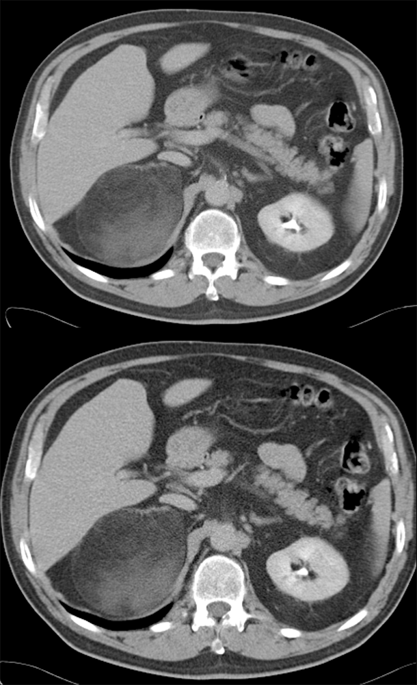 Adrenal Myelolipoma