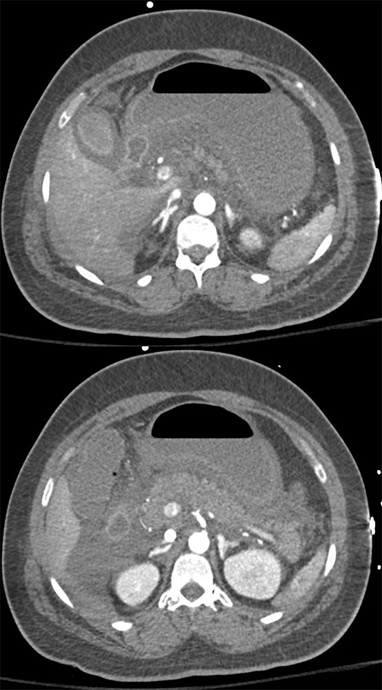 Hypotensive with Bright Adrenals S/P Intracranial Bleed