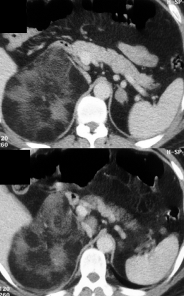 Adrenal Myelolipoma