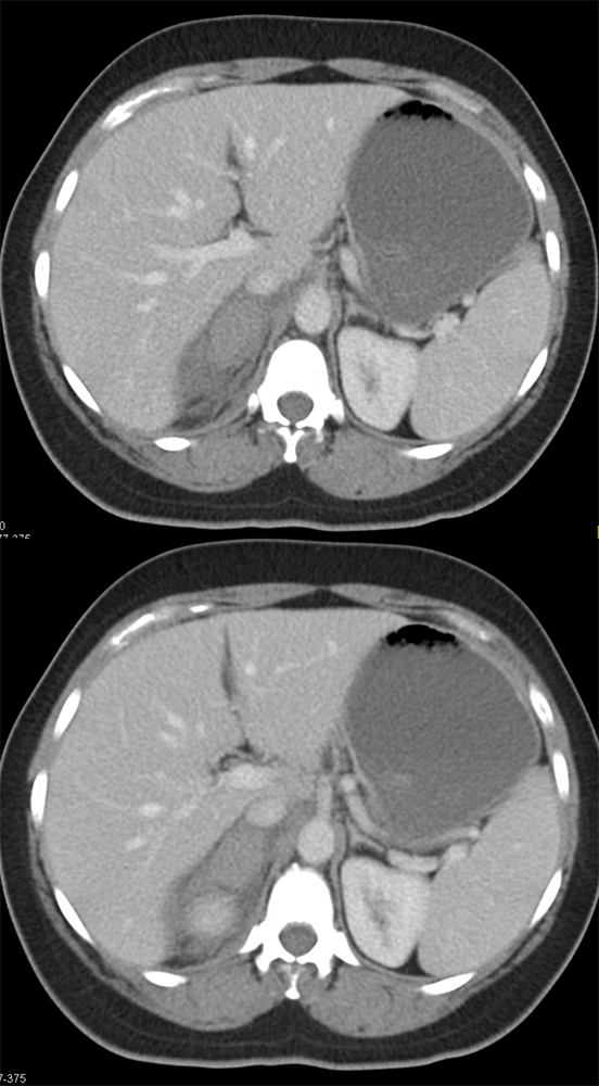 Adrenal Hemorrhage due to Coumadin