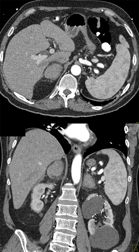 Bilateral Adrenal Hemorrhage due to Coumadin