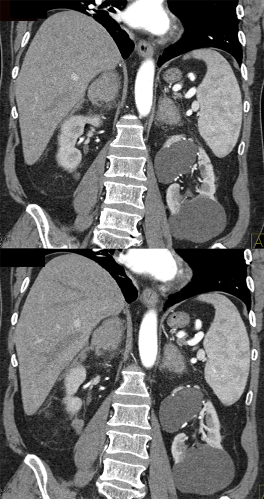 CT of the Adrenal Mass