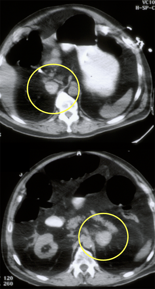 Bilateral Adrenal Hemorrhage in NICU Patient
