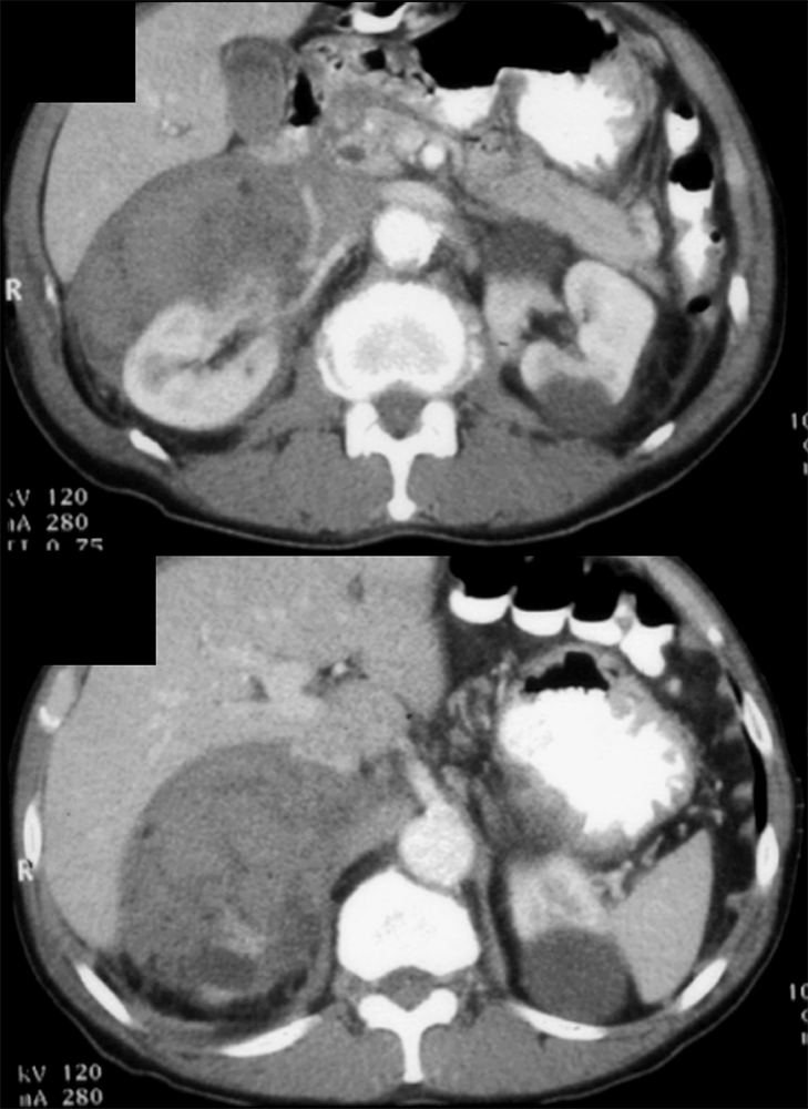 Adrenal Metastases with Hemorrhage