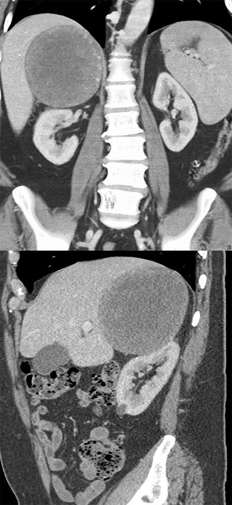 CT of the Adrenal Mass