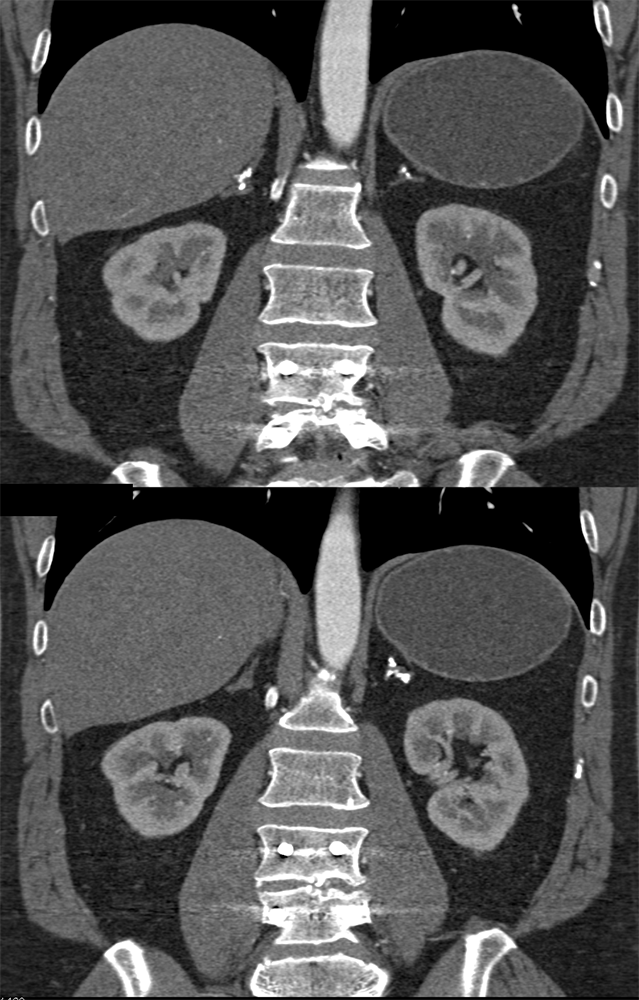 Prior Adrenal Hemorrhage