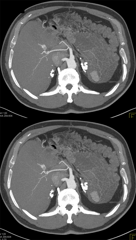 CT of the Adrenal Mass