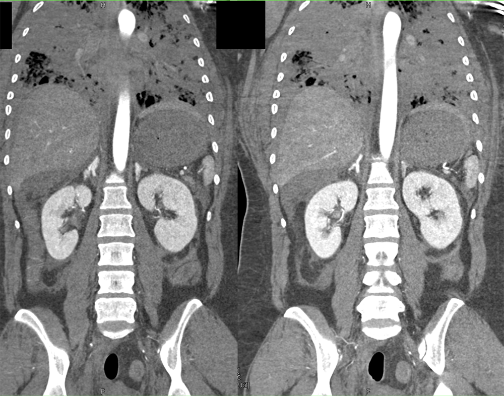 CT of the Adrenal Mass