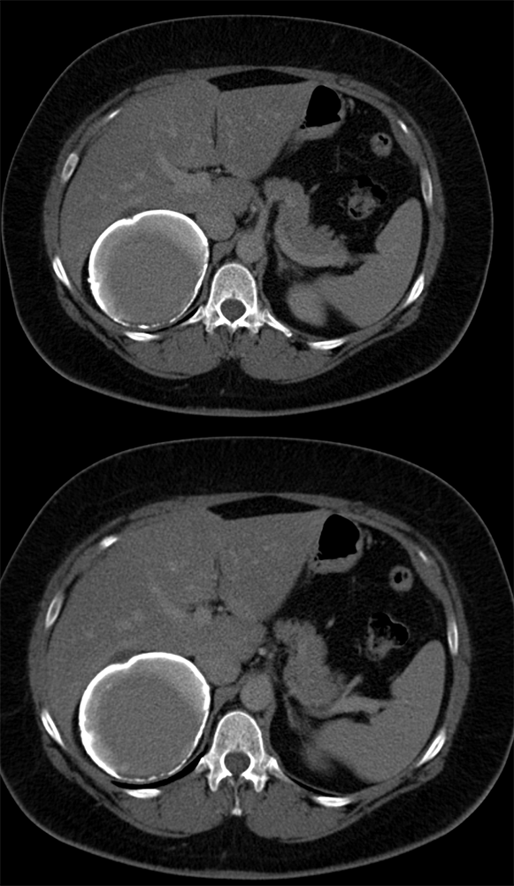 Old Adrenal Hematoma