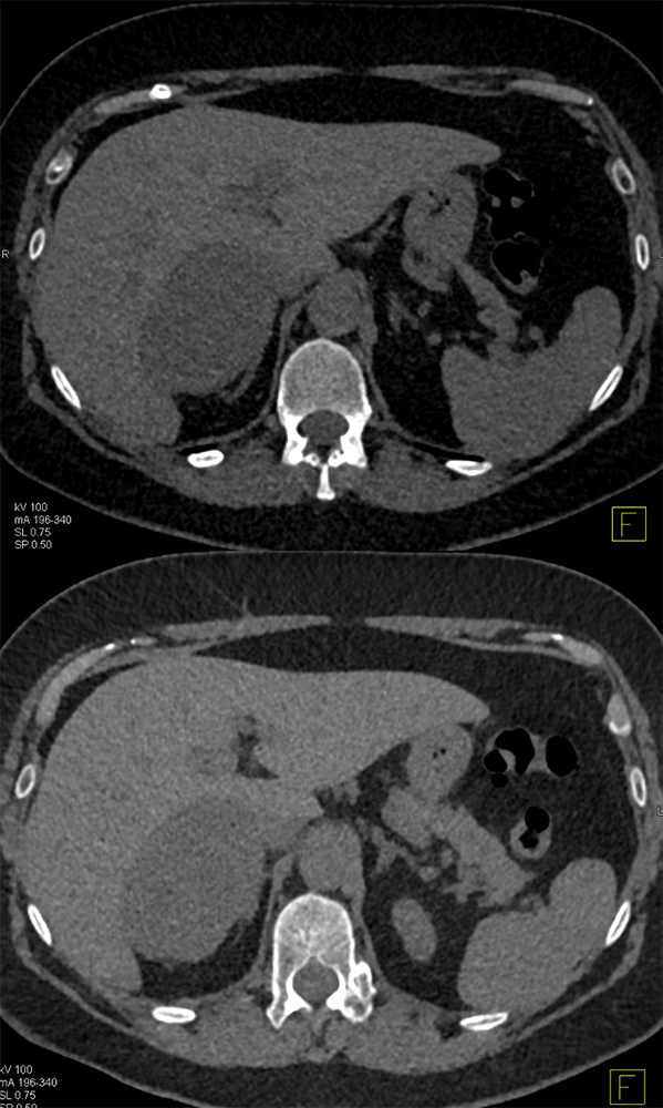 Primary Adrenal Cortical Carcinoma