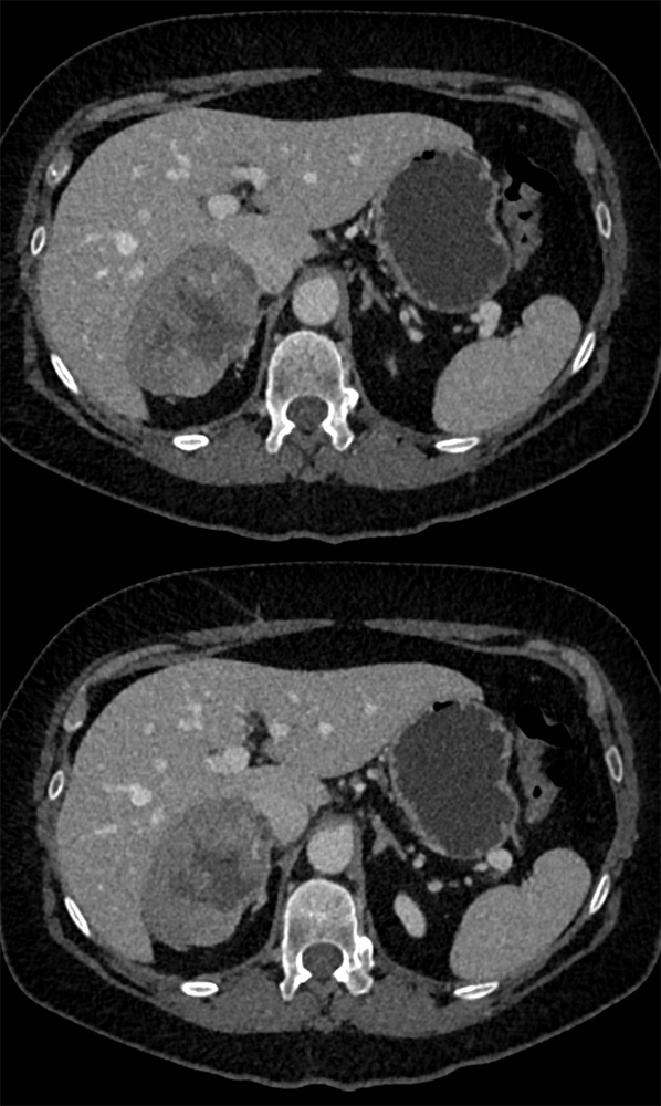 CT of the Adrenal Mass