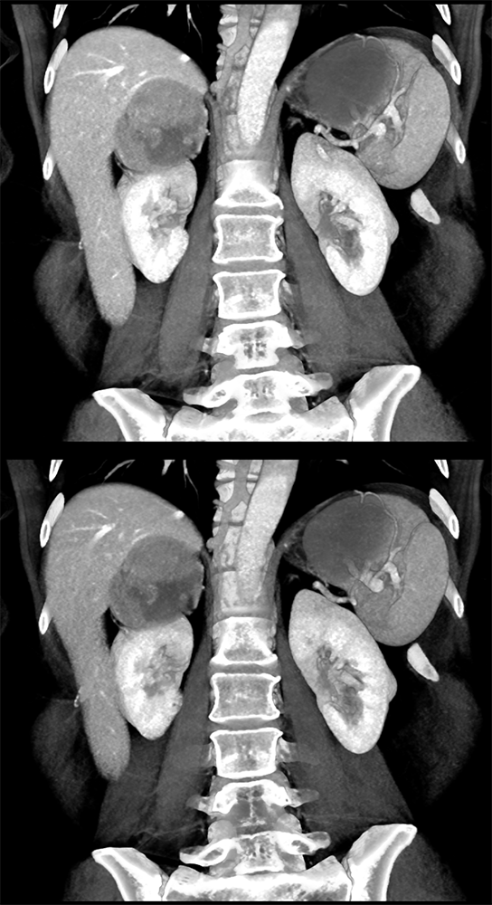 CT of the Adrenal Mass