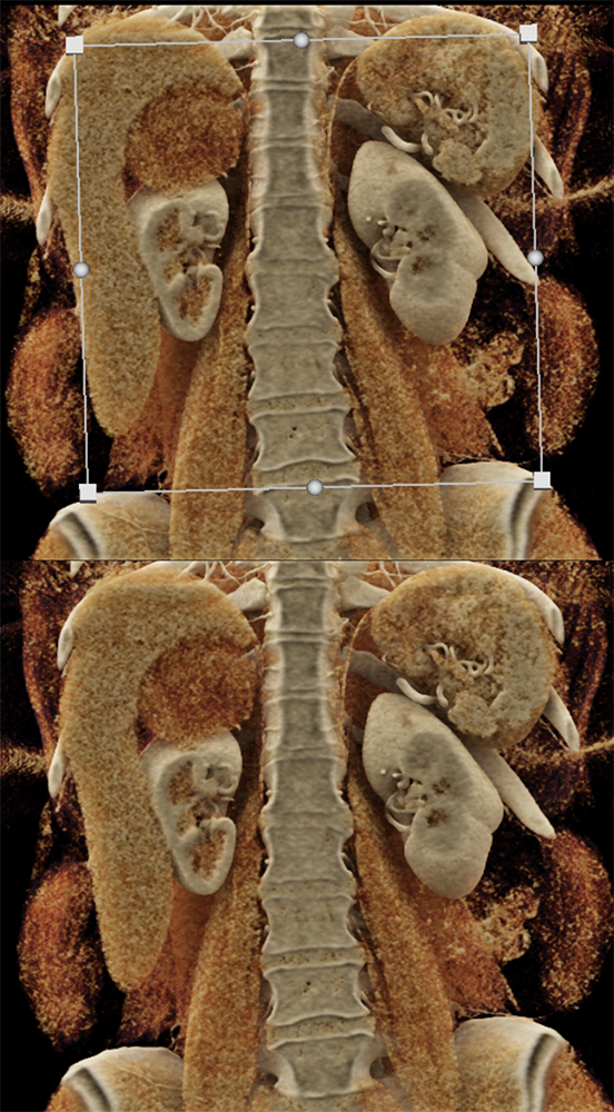 CT of the Adrenal Mass