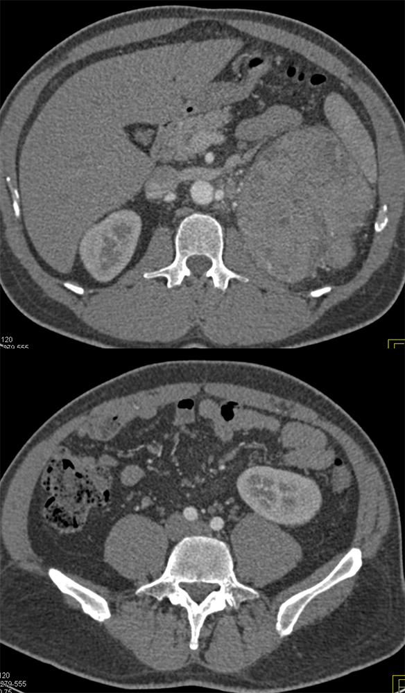 Primary Adrenal Carcinoma