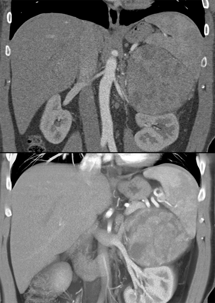 CT of the Adrenal Mass