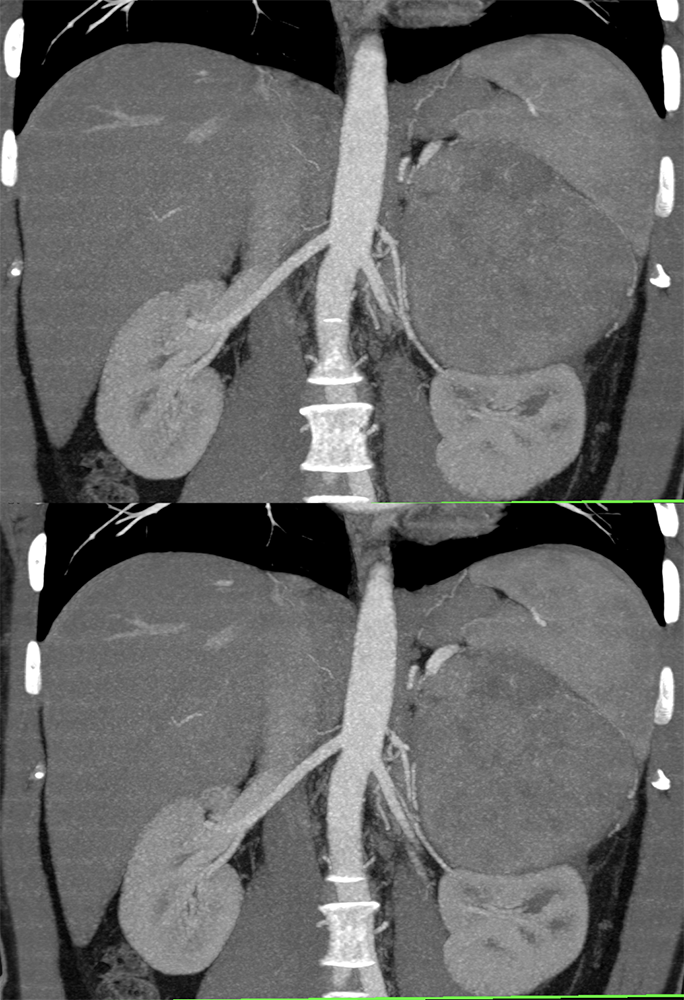 CT of the Adrenal Mass