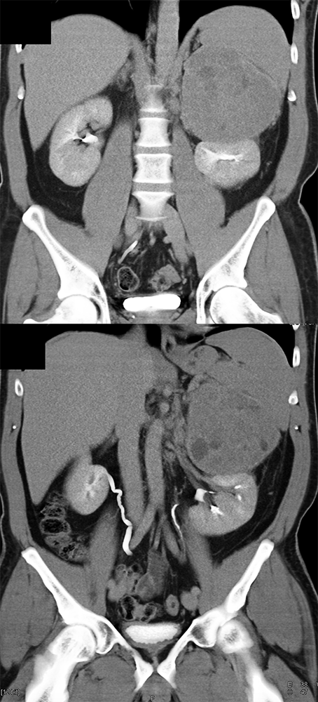 CT of the Adrenal Mass