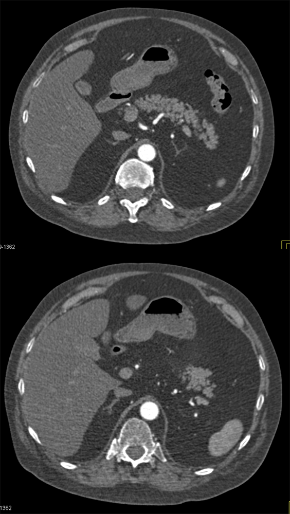 R/O Adrenal Mass in Patient with GBM and Back Pain-? Bleed