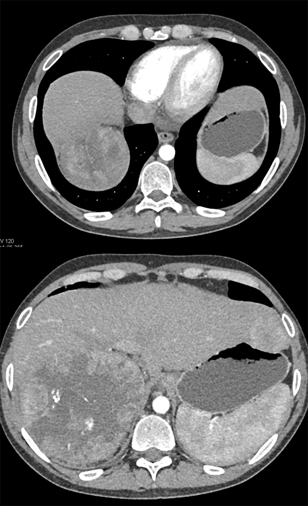 Primary Adrenal Cortical Carcinoma