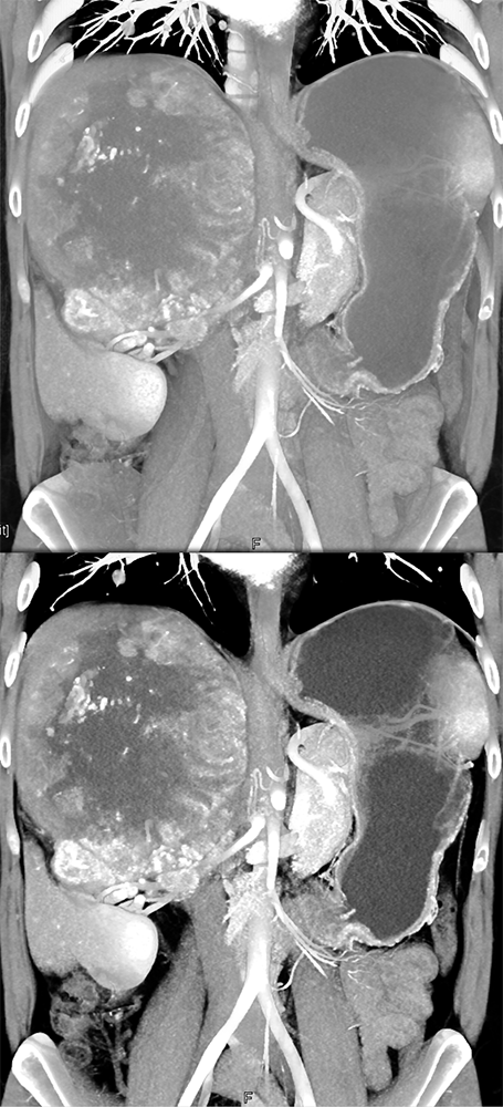 CT of the Adrenal Mass