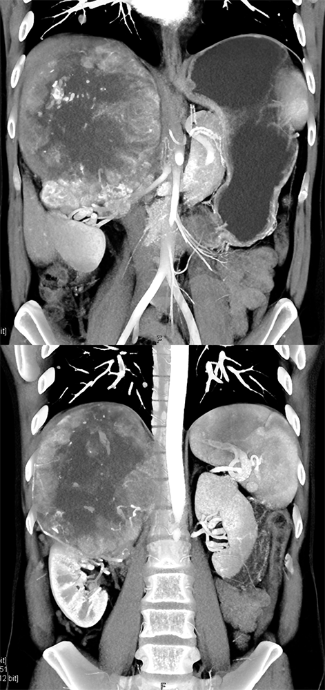 CT of the Adrenal Mass
