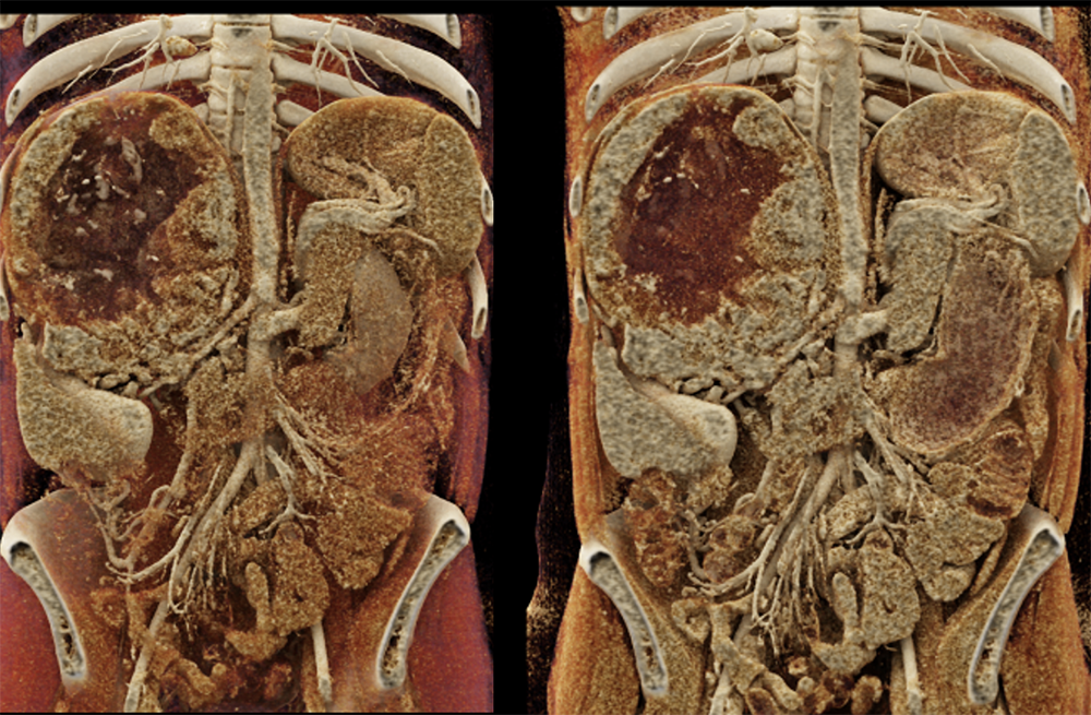 CT of the Adrenal Mass