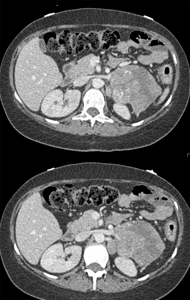 Adrenal Carcinoma in Patient with Ulcerative Colitis