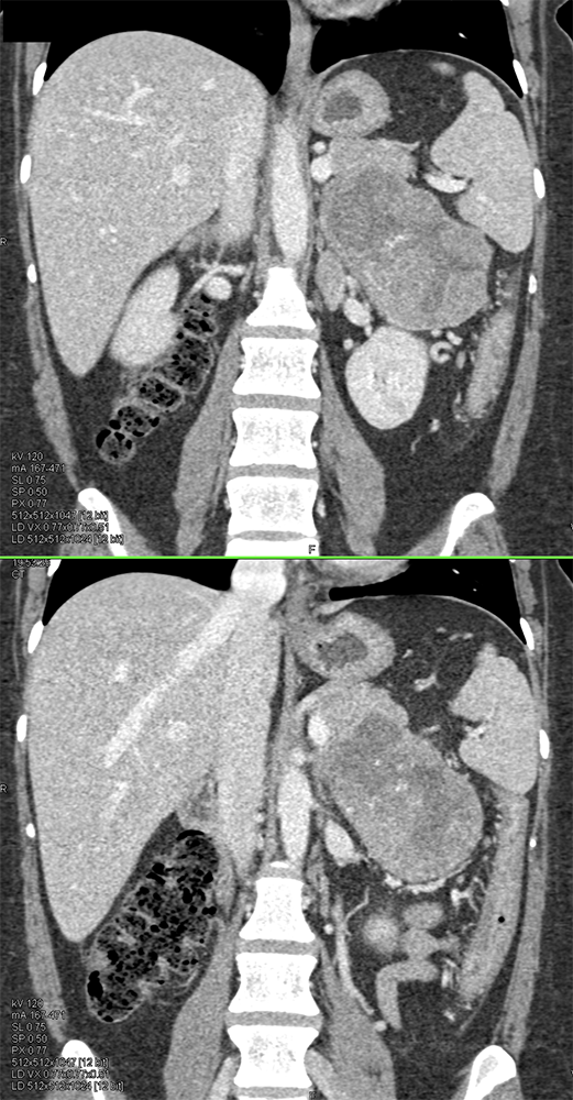 CT of the Adrenal Mass