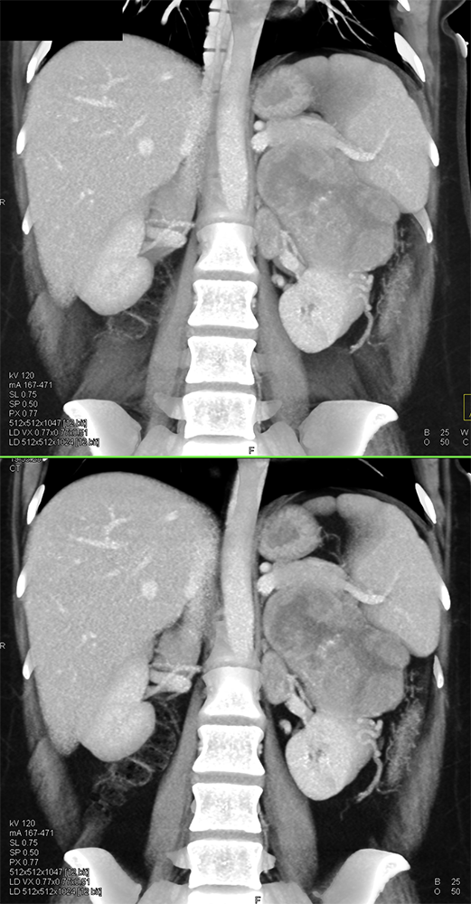 CT of the Adrenal Mass