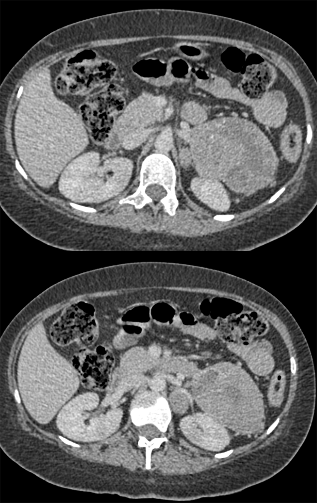 CT of the Adrenal Mass