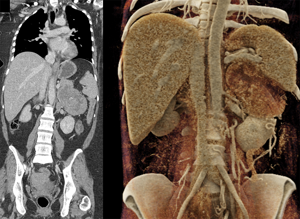 CT of the Adrenal Mass