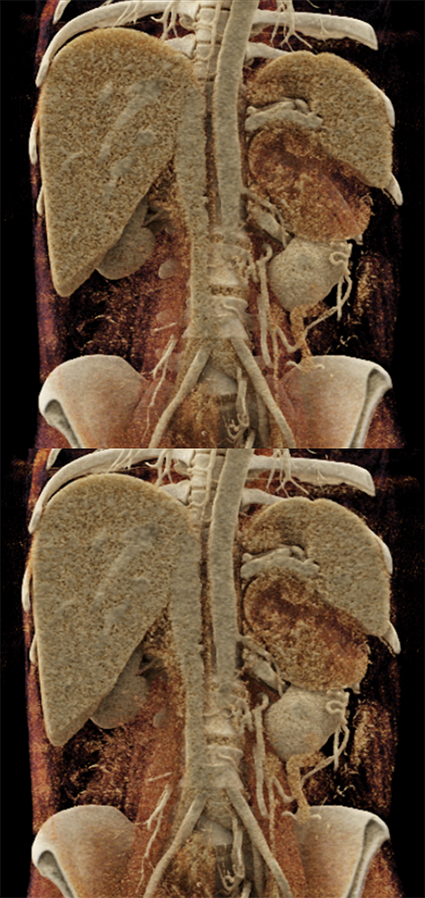 CT of the Adrenal Mass