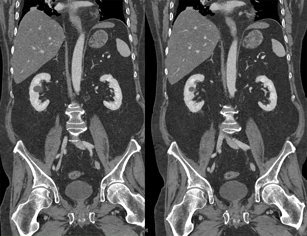 CT of the Adrenal Mass