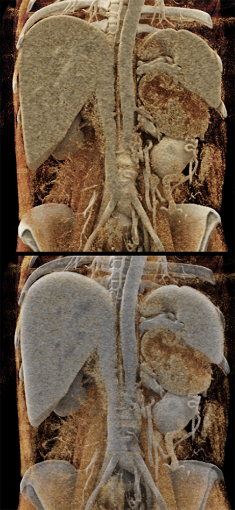 CT of the Adrenal Mass