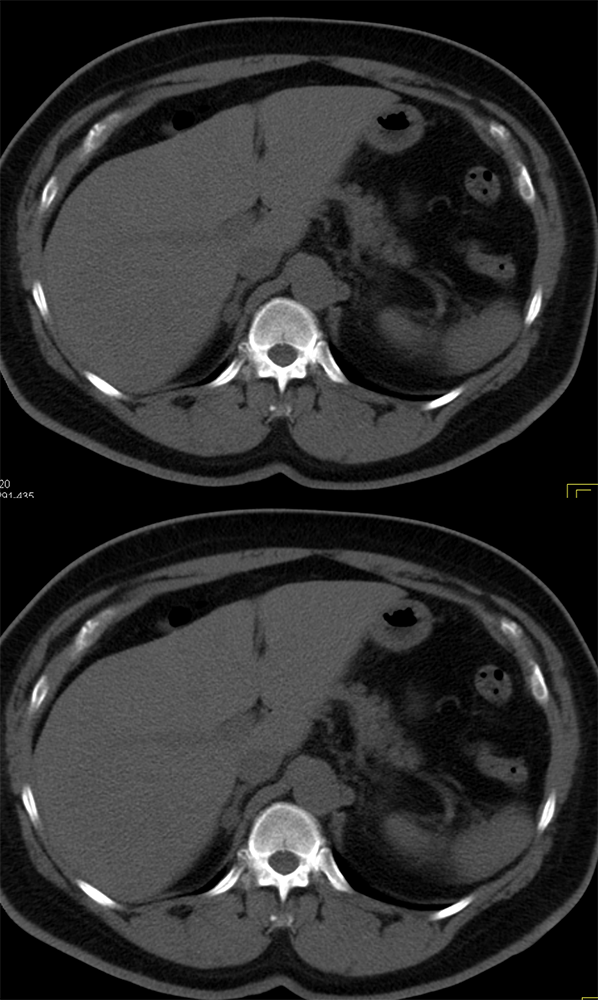 Primary AldosteronismAdrenal Cortical Carcinoma